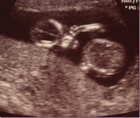 ultrasound baby pointing at us