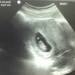 9 week ultrasound picture