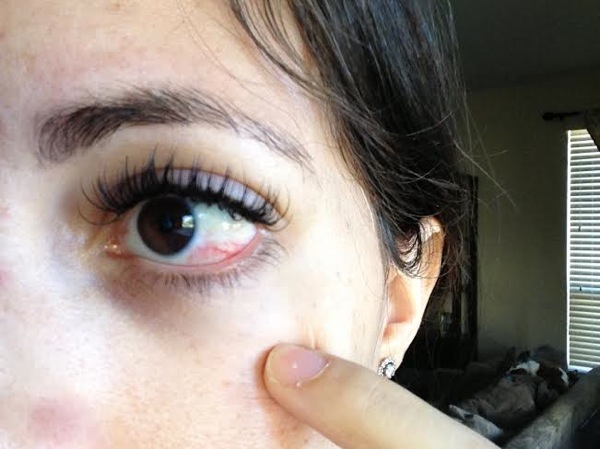 eyelash glue in eyeball