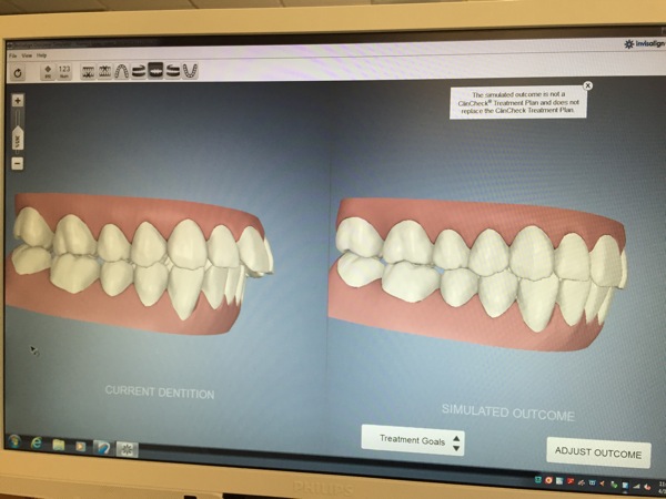 Invisalign1