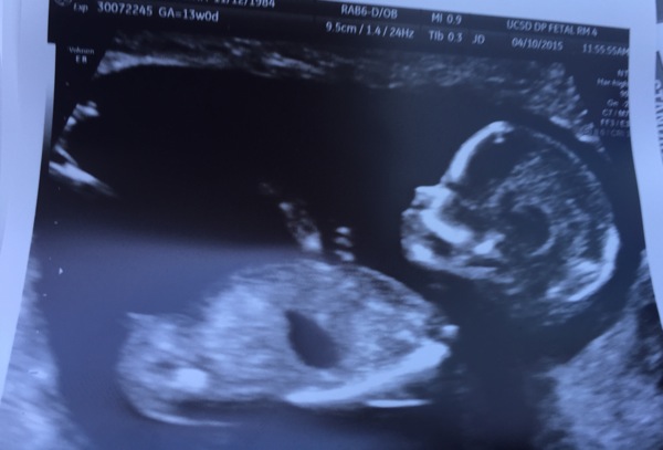 Ultrasound13weeks