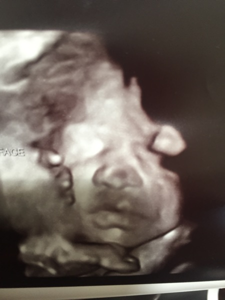 Ultrasound pic