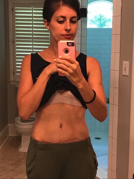 9days post op taking a small break from my faja : r/tummytucksurgery