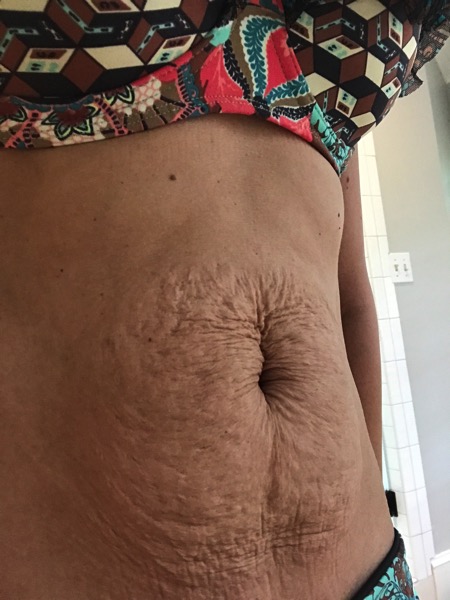 Breast Explant Surgery 3 Months Post Op 