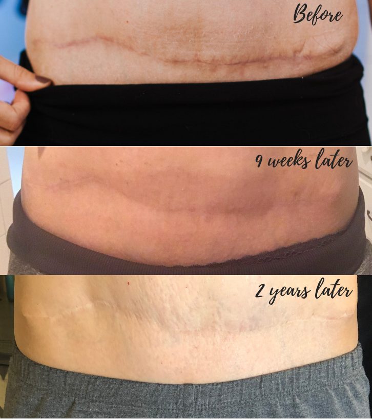 5 Tips To Minimize Tummy Tuck Scars