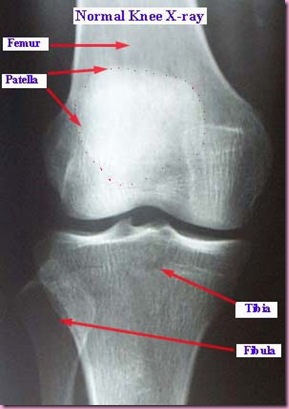 knee_xray_normal